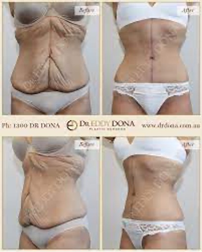 fleur de lis tummy tuck - Online Discount Shop for Electronics, Apparel, Toys, Books, Games, Computers, Shoes, Jewelry, Watches, Baby Products, Sports & Outdoors, Office Products, Bed & Bath, Furniture, Tools, Hardware,