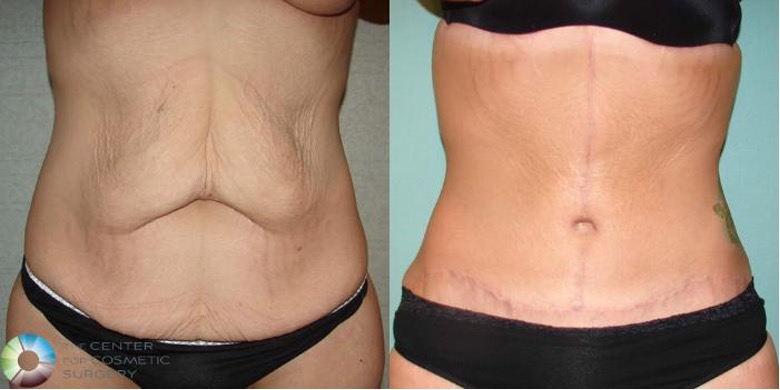 Arm Lift Before and After Pictures Case 508 | Golden, CO | The Center for Cosmetic Surgery